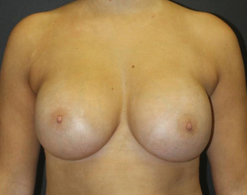 Breast Augmentation Before & After Gallery - Patient 423101 - Image 2