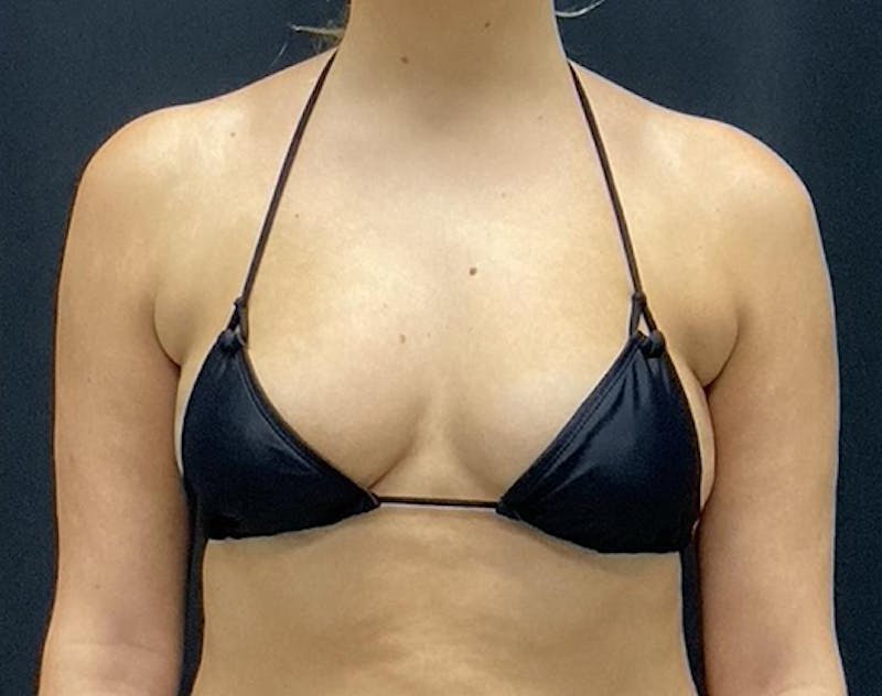 Breast Augmentation Before & After Gallery - Patient 423101 - Image 11
