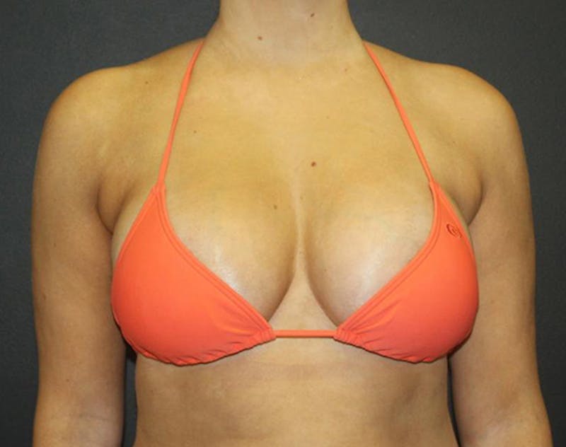 Breast Augmentation Before & After Gallery - Patient 423101 - Image 12