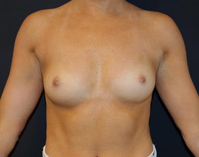 Breast Augmentation Before & After Gallery - Patient 338372 - Image 1