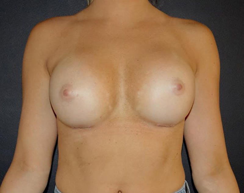 Breast Augmentation Before & After Gallery - Patient 338372 - Image 2