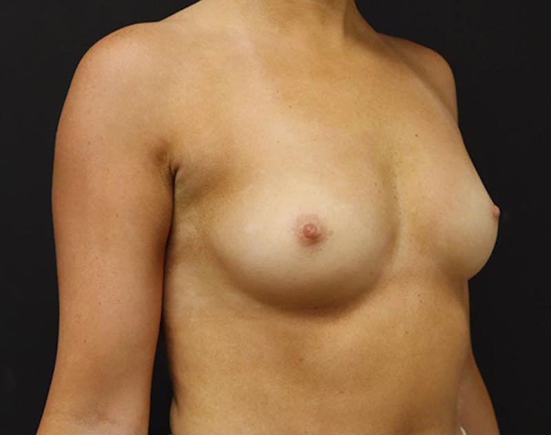 Breast Augmentation Before & After Gallery - Patient 338372 - Image 3