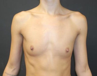 Breast Augmentation Before & After Gallery - Patient 162074 - Image 1