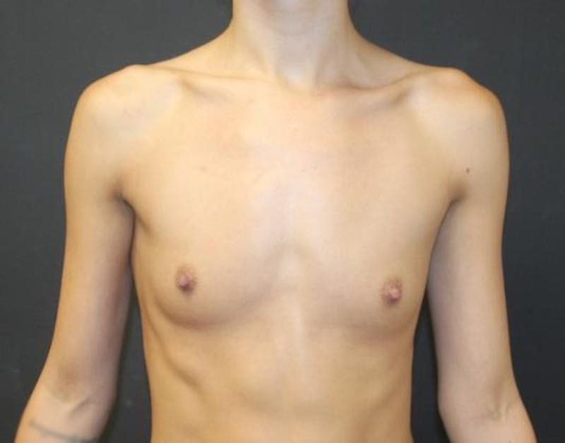 Breast Augmentation Before & After Gallery - Patient 162074 - Image 1