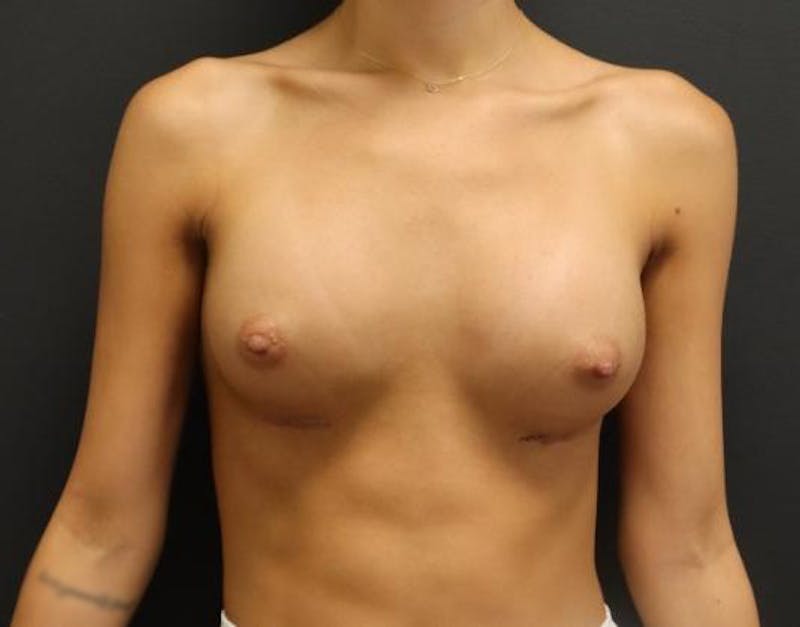 Breast Augmentation Before & After Gallery - Patient 162074 - Image 2