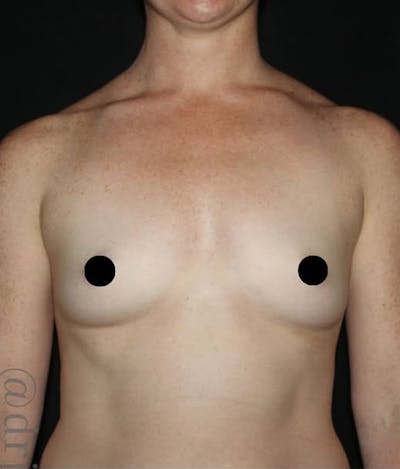 Breast Augmentation Before & After Gallery - Patient 322948 - Image 1