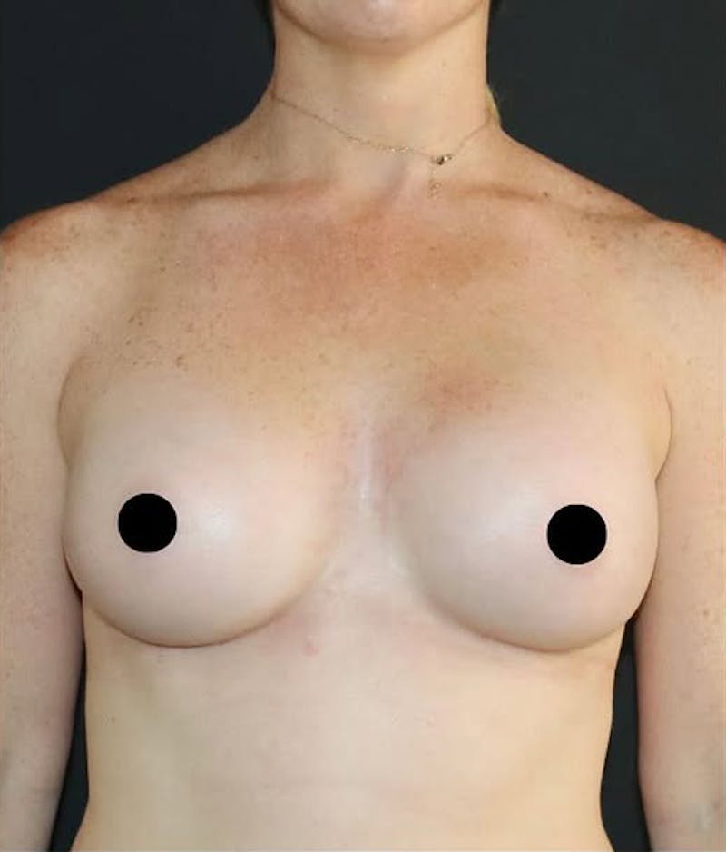 Breast Augmentation Before & After Gallery - Patient 322948 - Image 2