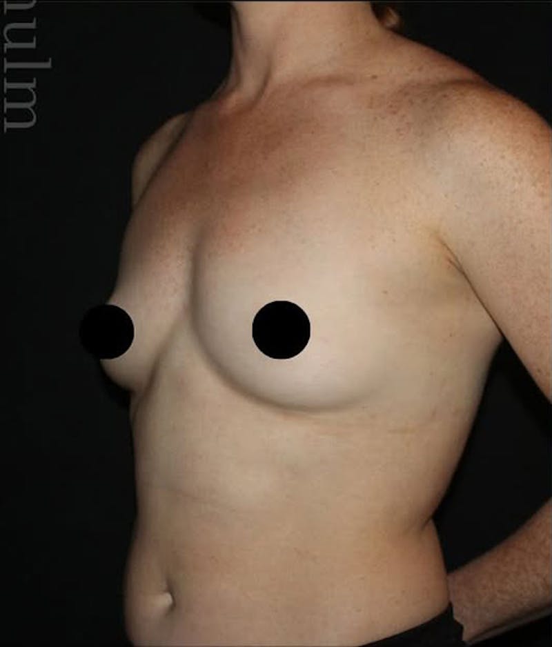 Breast Augmentation Before & After Gallery - Patient 322948 - Image 3