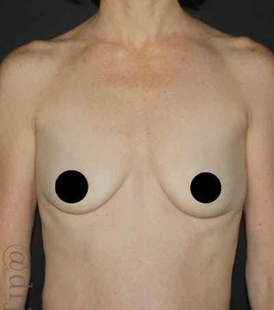 Breast Augmentation Before & After Gallery - Patient 334698 - Image 1
