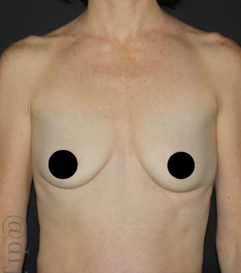 Breast Augmentation Before & After Gallery - Patient 334698 - Image 1