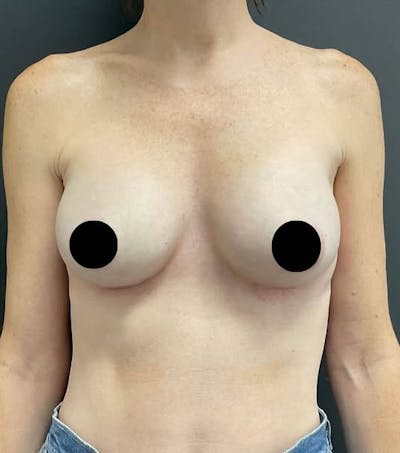Breast Augmentation Before & After Gallery - Patient 334698 - Image 2