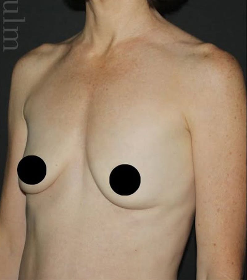 Breast Augmentation Before & After Gallery - Patient 334698 - Image 3