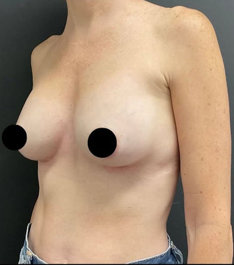 Breast Augmentation Before & After Gallery - Patient 334698 - Image 4