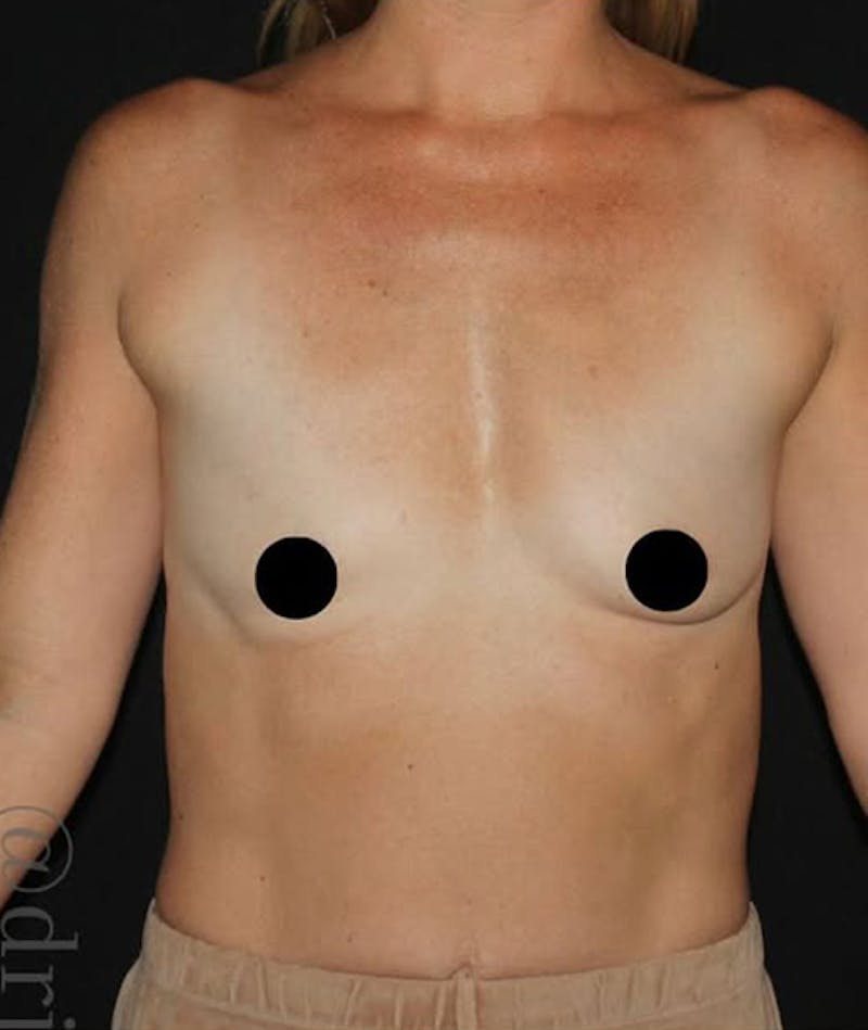 Breast Augmentation Before & After Gallery - Patient 146900 - Image 1