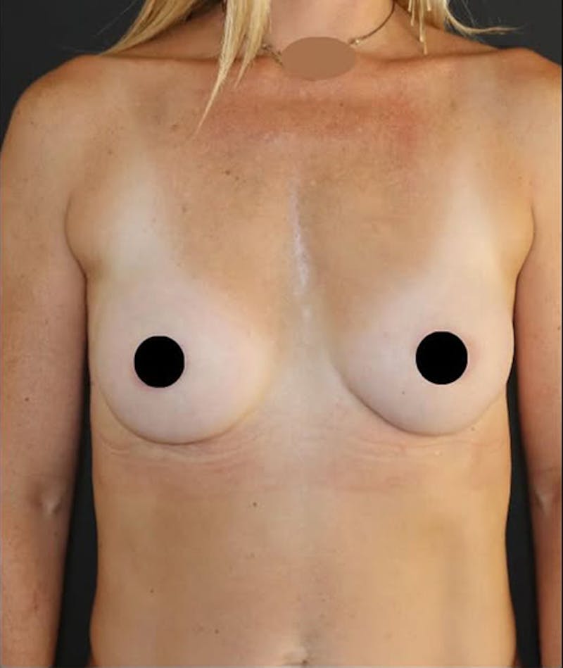 Breast Augmentation Before & After Gallery - Patient 146900 - Image 2