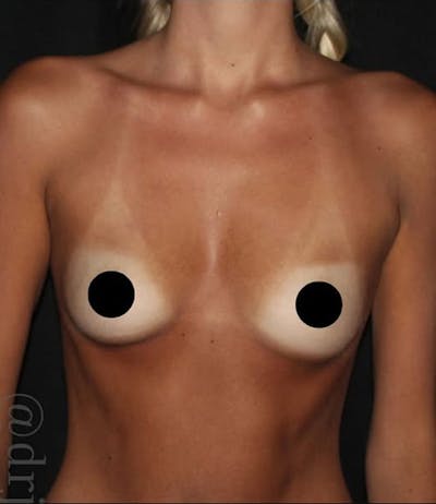 Breast Augmentation Before & After Gallery - Patient 229692 - Image 1