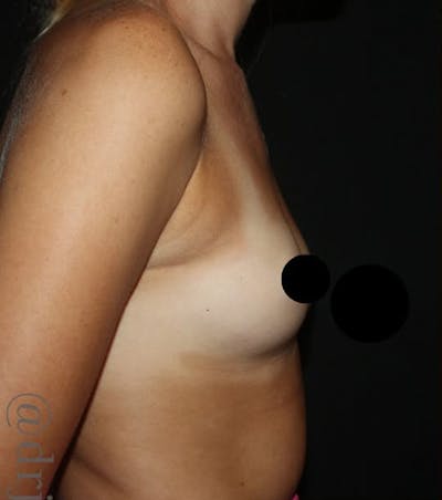 Breast Augmentation Before & After Gallery - Patient 326043 - Image 1