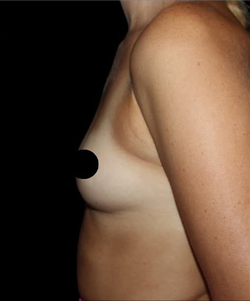 Breast Augmentation Before & After Gallery - Patient 326043 - Image 3