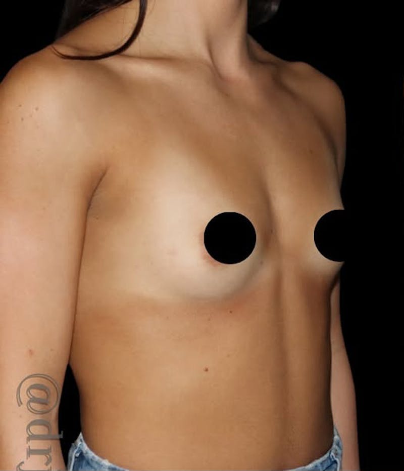 Breast Augmentation Before & After Gallery - Patient 749432 - Image 1
