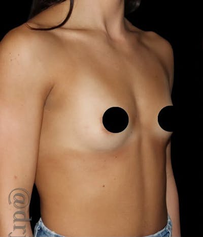 Breast Augmentation Before & After Gallery - Patient 749432 - Image 1