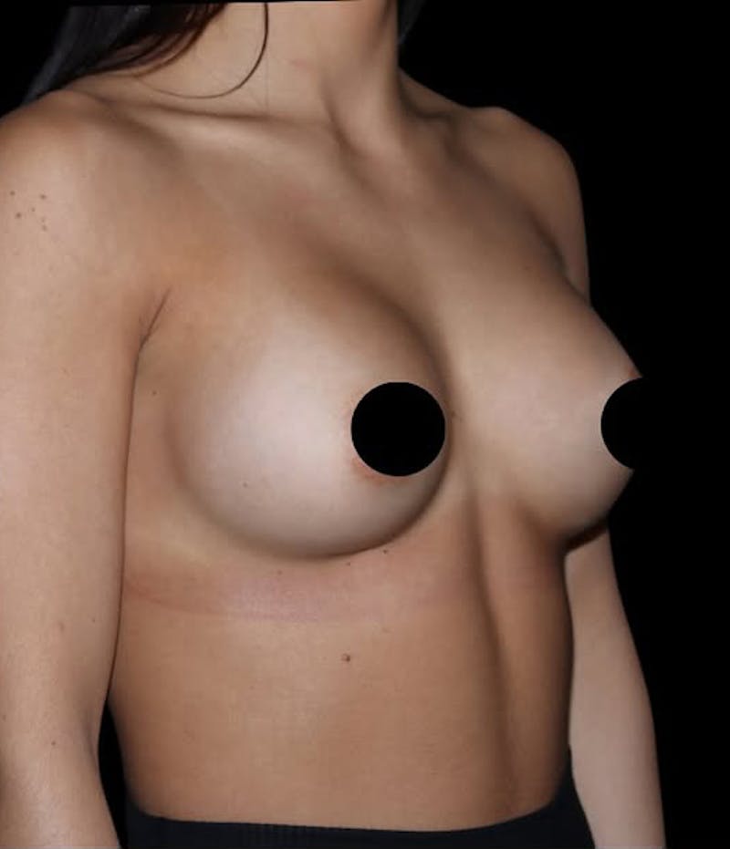 Breast Augmentation Before & After Gallery - Patient 749432 - Image 2