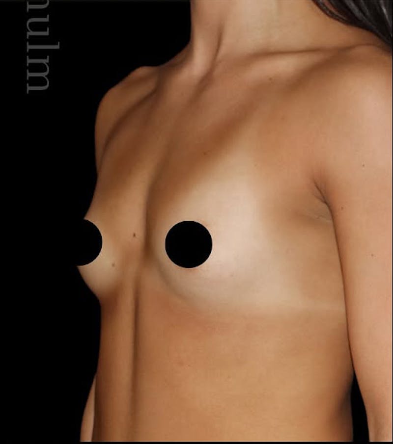 Breast Augmentation Before & After Gallery - Patient 749432 - Image 3