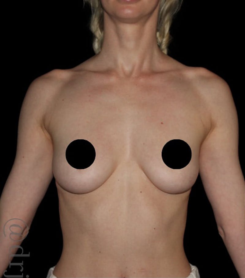 Breast Augmentation Before & After Gallery - Patient 866778 - Image 1