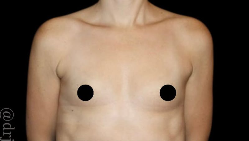 Breast Augmentation Before & After Gallery - Patient 139050 - Image 1