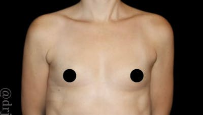 Breast Augmentation Before & After Gallery - Patient 139050 - Image 1