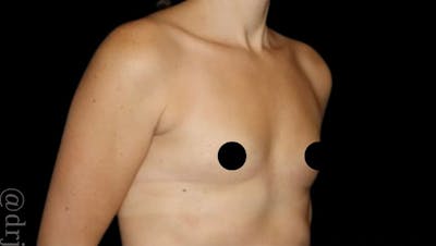 Breast Augmentation Before & After Gallery - Patient 139050 - Image 2