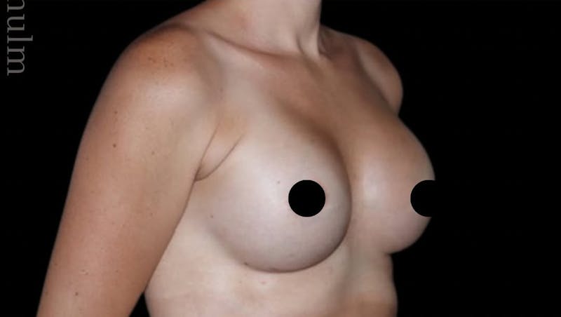 Breast Augmentation Before & After Gallery - Patient 139050 - Image 3