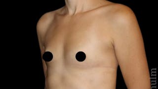 Breast Augmentation Before & After Gallery - Patient 139050 - Image 4