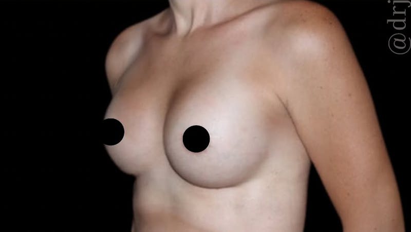 Breast Augmentation Before & After Gallery - Patient 139050 - Image 5