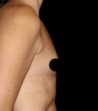 Breast Augmentation Before & After Gallery - Patient 139050 - Image 6