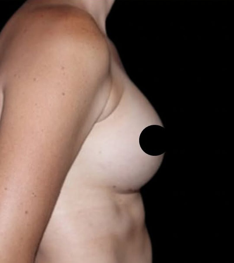 Breast Augmentation Before & After Gallery - Patient 139050 - Image 7