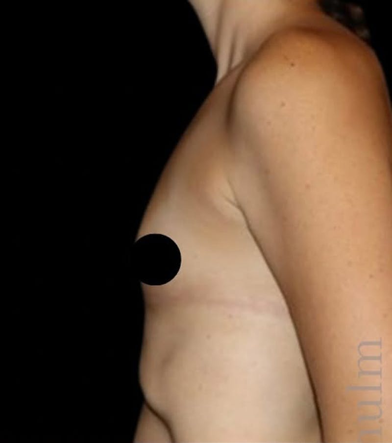 Breast Augmentation Before & After Gallery - Patient 139050 - Image 8