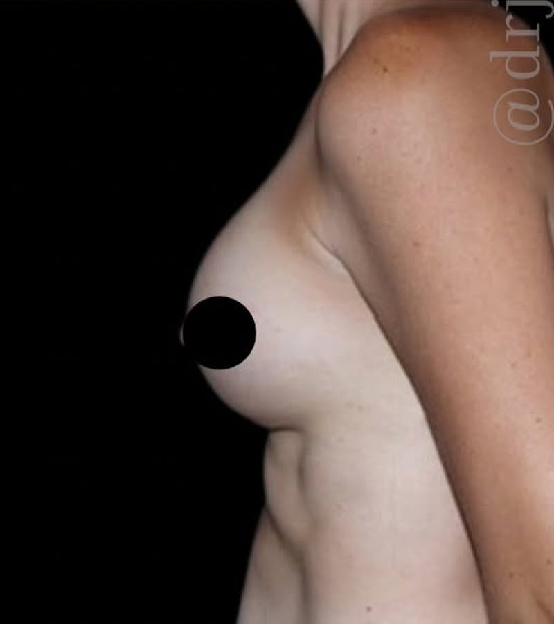 Breast Augmentation Before & After Gallery - Patient 139050 - Image 9