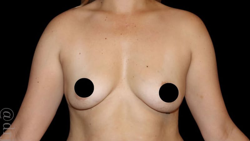 Breast Augmentation Before & After Gallery - Patient 486727 - Image 1