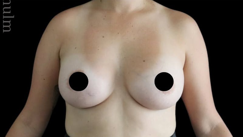 Breast Augmentation Before & After Gallery - Patient 486727 - Image 2