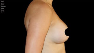 Breast Augmentation Before & After Gallery - Patient 486727 - Image 4