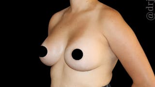 Breast Augmentation Before & After Gallery - Patient 486727 - Image 6