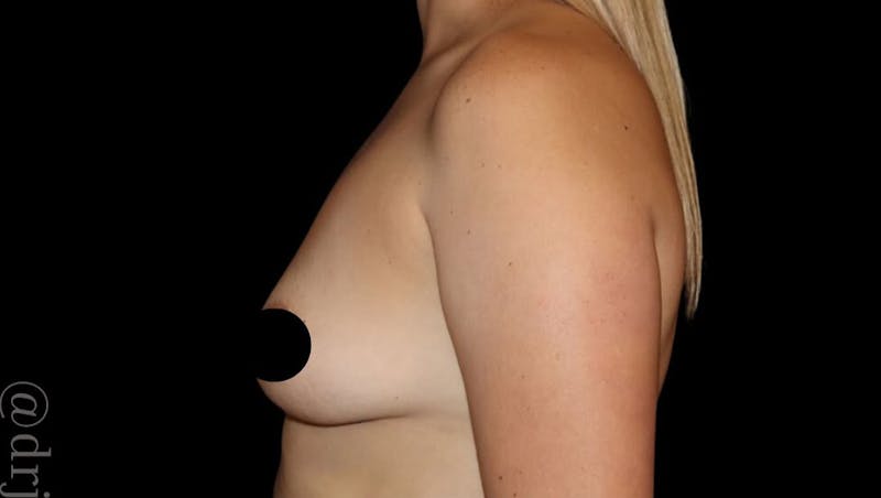 Breast Augmentation Before & After Gallery - Patient 486727 - Image 7