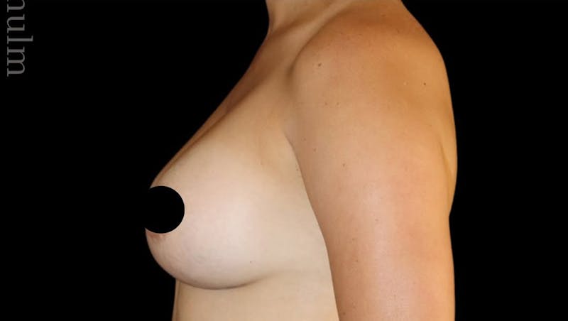 Breast Augmentation Before & After Gallery - Patient 486727 - Image 8