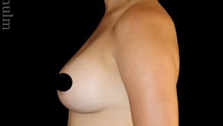 Breast Augmentation Before & After Gallery - Patient 486727 - Image 8