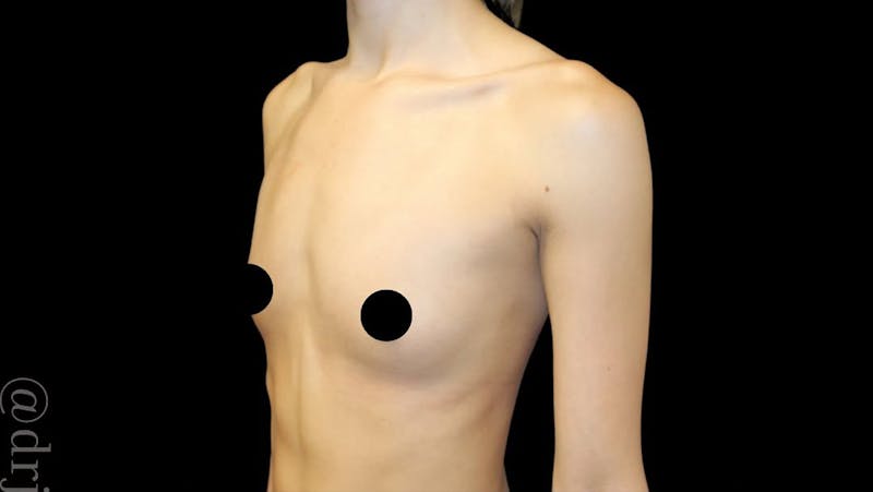 Breast Augmentation Before & After Gallery - Patient 974735 - Image 1