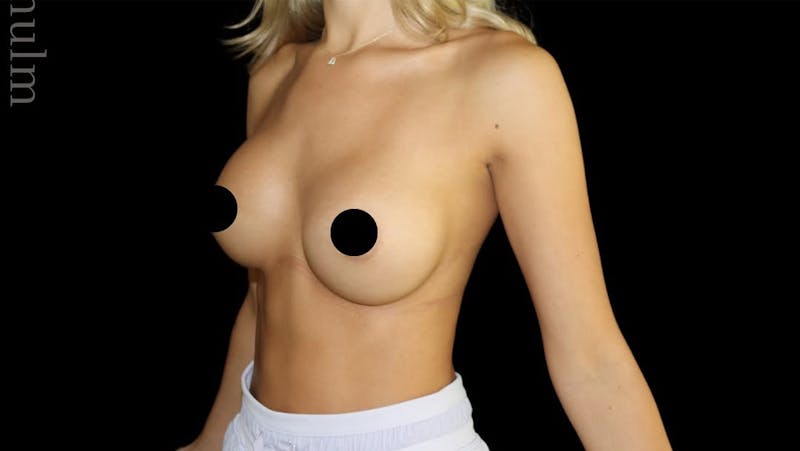 Breast Augmentation Before & After Gallery - Patient 974735 - Image 2