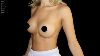 Breast Augmentation Before & After Gallery - Patient 974735 - Image 2