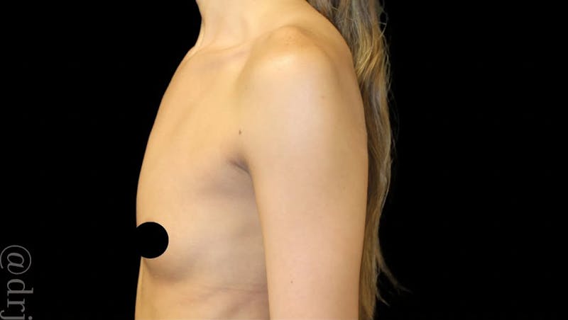 Breast Augmentation Before & After Gallery - Patient 974735 - Image 3