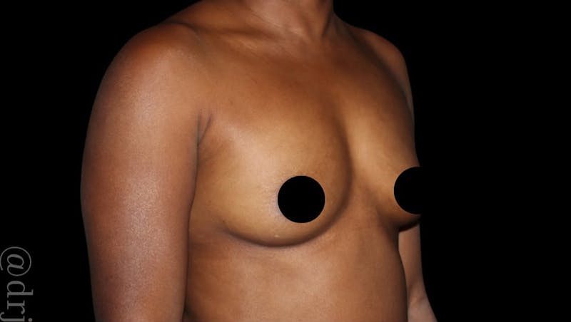 Breast Augmentation Before & After Gallery - Patient 139047 - Image 1