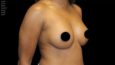 Breast Augmentation Before & After Gallery - Patient 139047 - Image 2